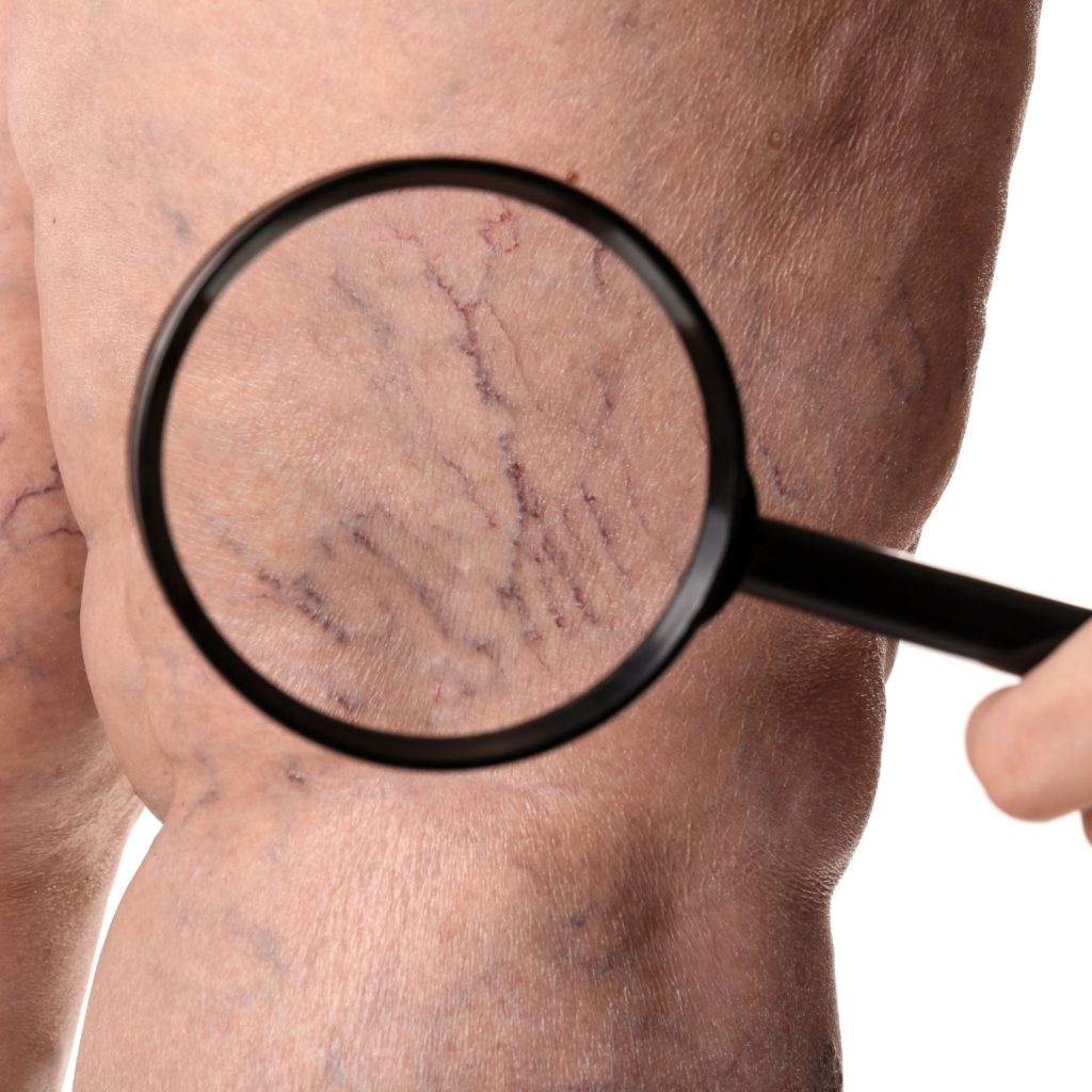 Elimina Micro Vasos